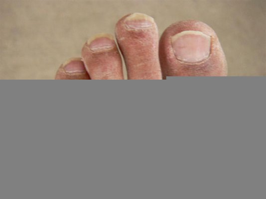 toe_ring.jpg